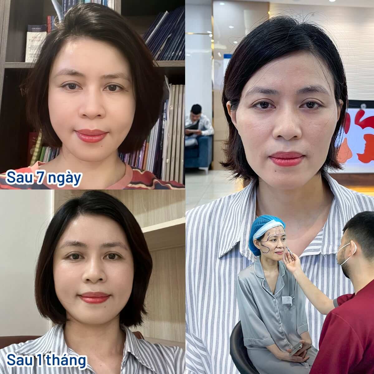 Quá trình thay đổi của chị Thanh Nhàn sau khi cấy mỡ Matix 3D