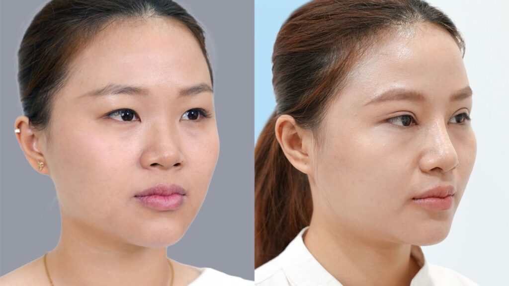 Hành trình 10 ngày khắc phục mũi tẹt, mắt mí ẩn của Diệu Hiền