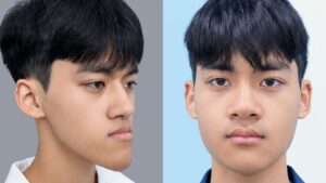 Lấy lại khuôn mặt cân đối sau chỉnh hàm móm 3D tại Kangnam của Đình Quyết