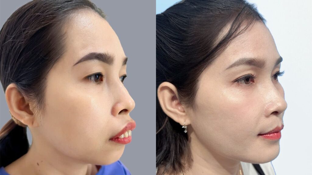 Sau 30 ngày chỉnh hàm hô 3D và trượt cằm khách hàng Trần Thị Loan lột xác ngoạn mục