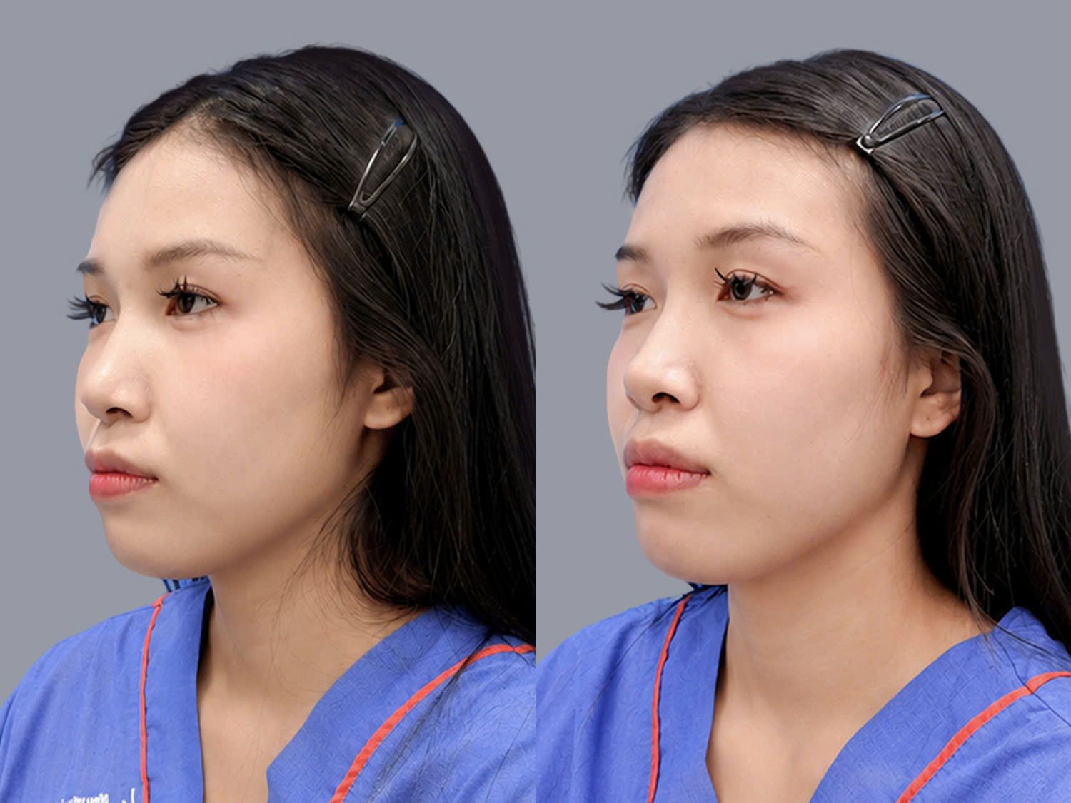 Ngọc Trâm gặp tình trạng hàm hô, phát triển quá mức