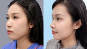 Hành trình khắc phục hàm hô của Gen Z Nguyễn Ngọc Trâm tại Kangnam Sài Gòn