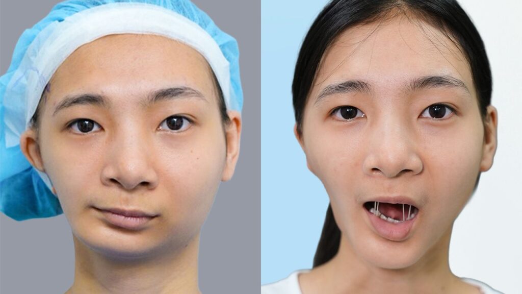 60 ngày khắc phục hàm “lượn sóng” của Nguyễn Thị Diệu tại Kangnam