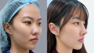 Sau 10 ngày nâng mũi cấu trúc Idol Ngọc Ni sở hữu dáng mũi cao chuẩn tỉ lệ vàng
