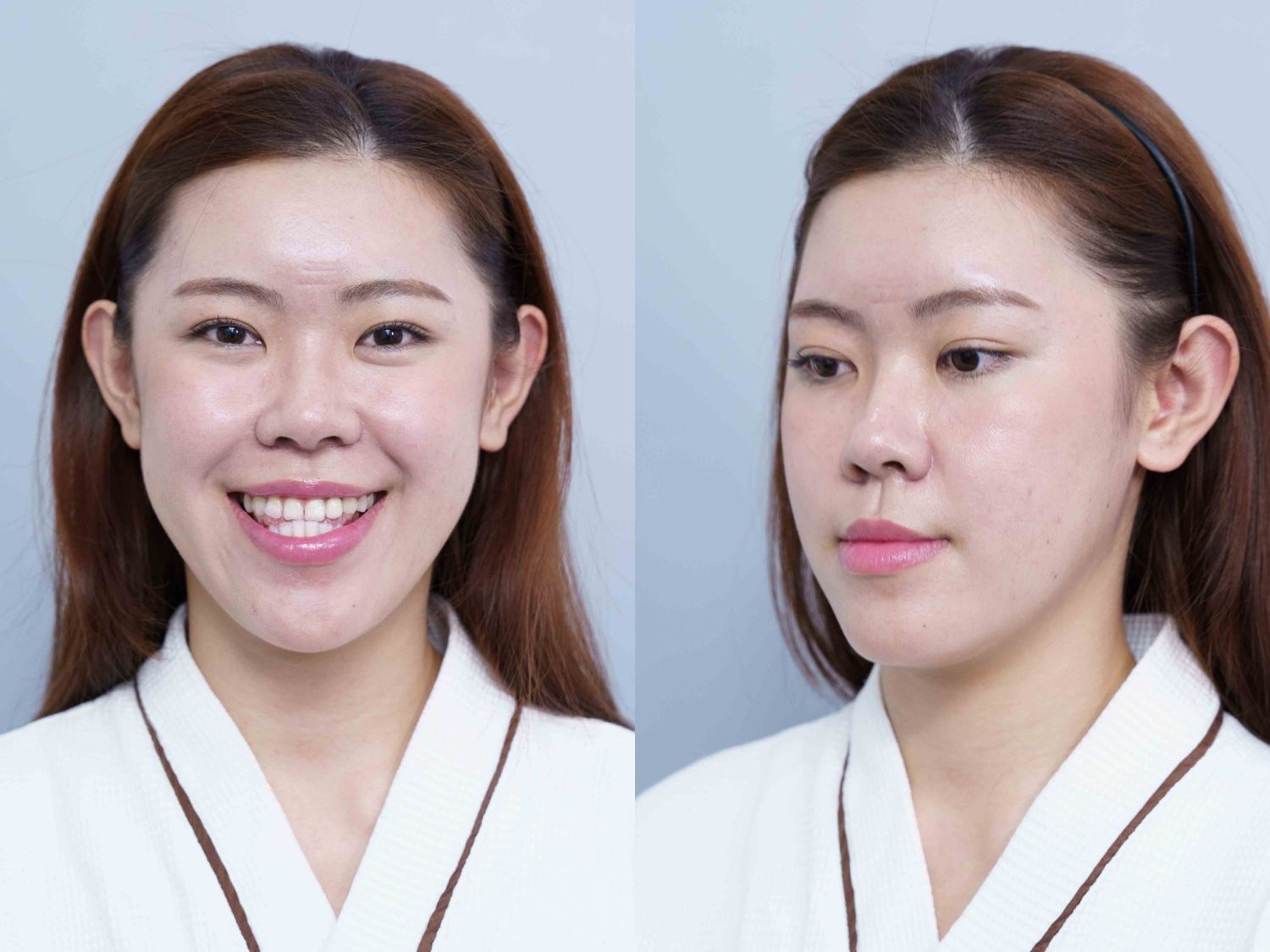 Phương Anh gặp tình trạng khớp cắn ngược, hàm móm