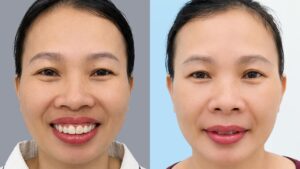 20 ngày “lột xác” khuyết điểm hàm hô, cằm lẹm của chị Hồng Thanh