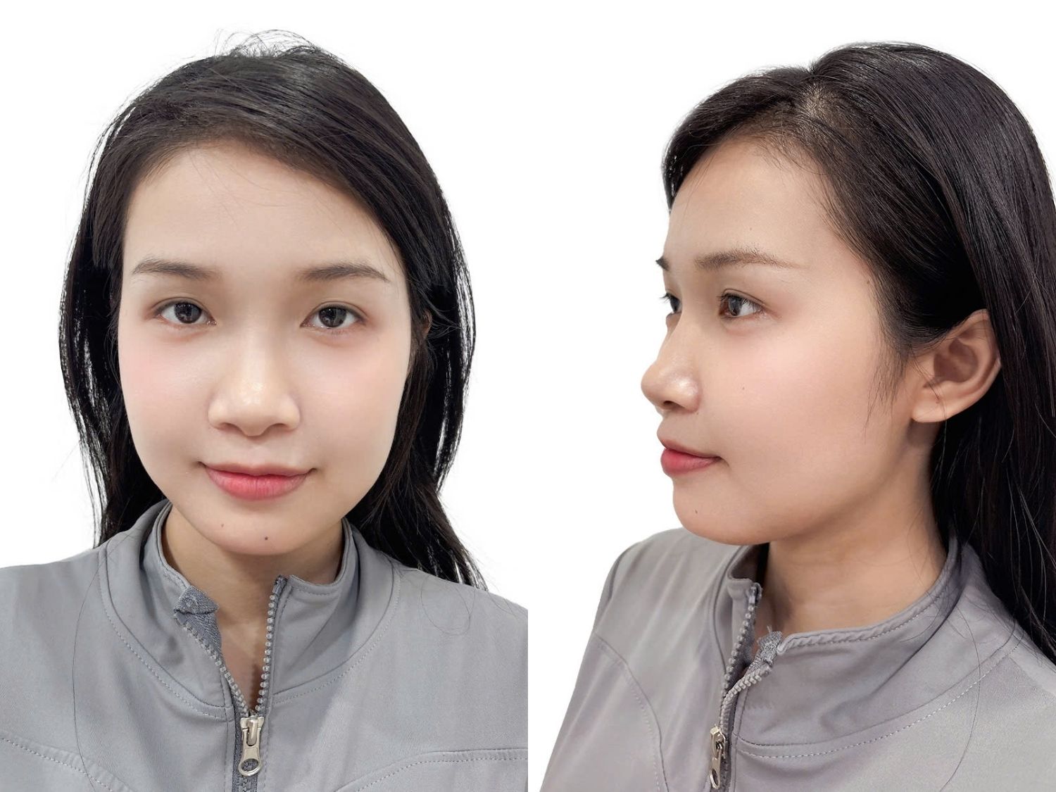 Sau phẫu thuật Ngọc Trâm sở hữu khuôn mặt cân đối, trẻ trung khắc phục tình trạng hàm hô hoàn toàn