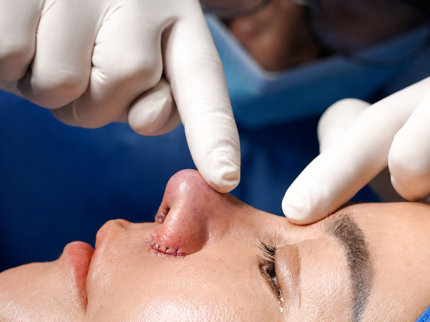 Sau nâng mũi chị Mai đã sở hữu dáng mũi cao tức thì