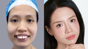 Sau 30 ngày khắc phục hàm hô nặng bằng combo chỉnh hàm của cô gái siêu vẩu Vũ Thị Tình