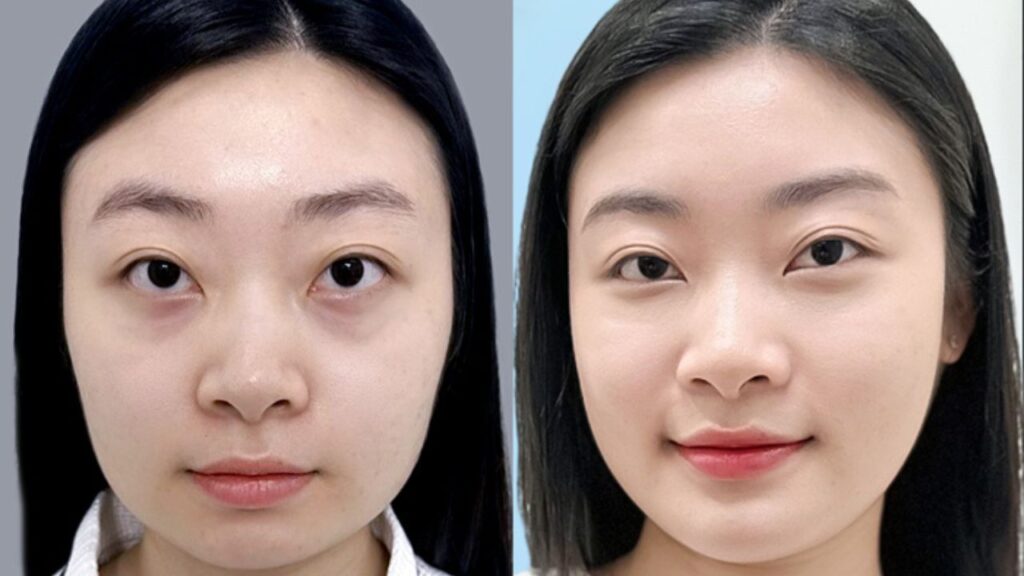 Tạm biệt hàm vuông to bạnh sau 14 ngày của Yến Nhi tại Kangnam Hà Nội