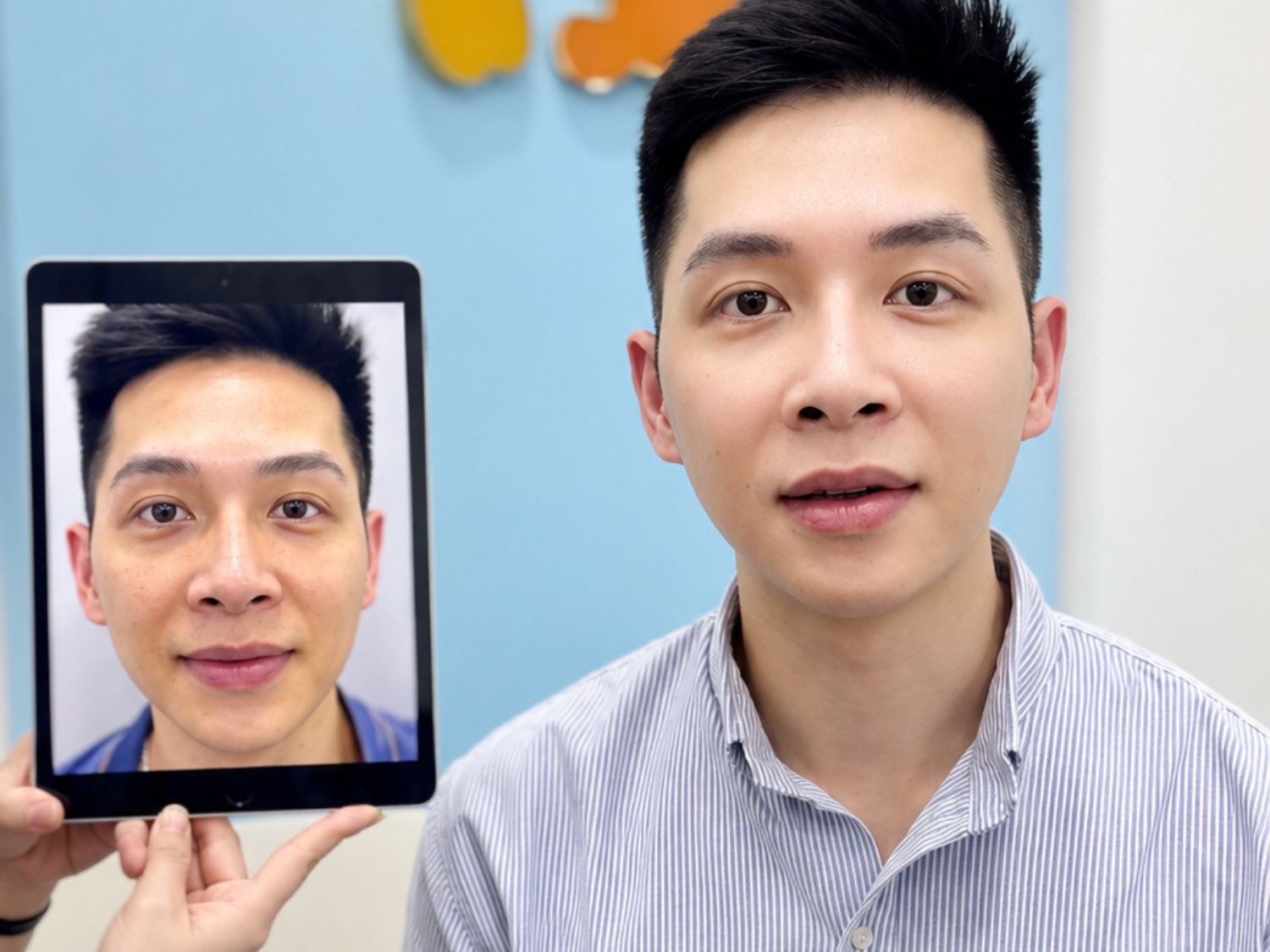 Sau cấy mỡ 2 tuần gương mặt của anh đã tươi trẻ và đầy đặn hơn