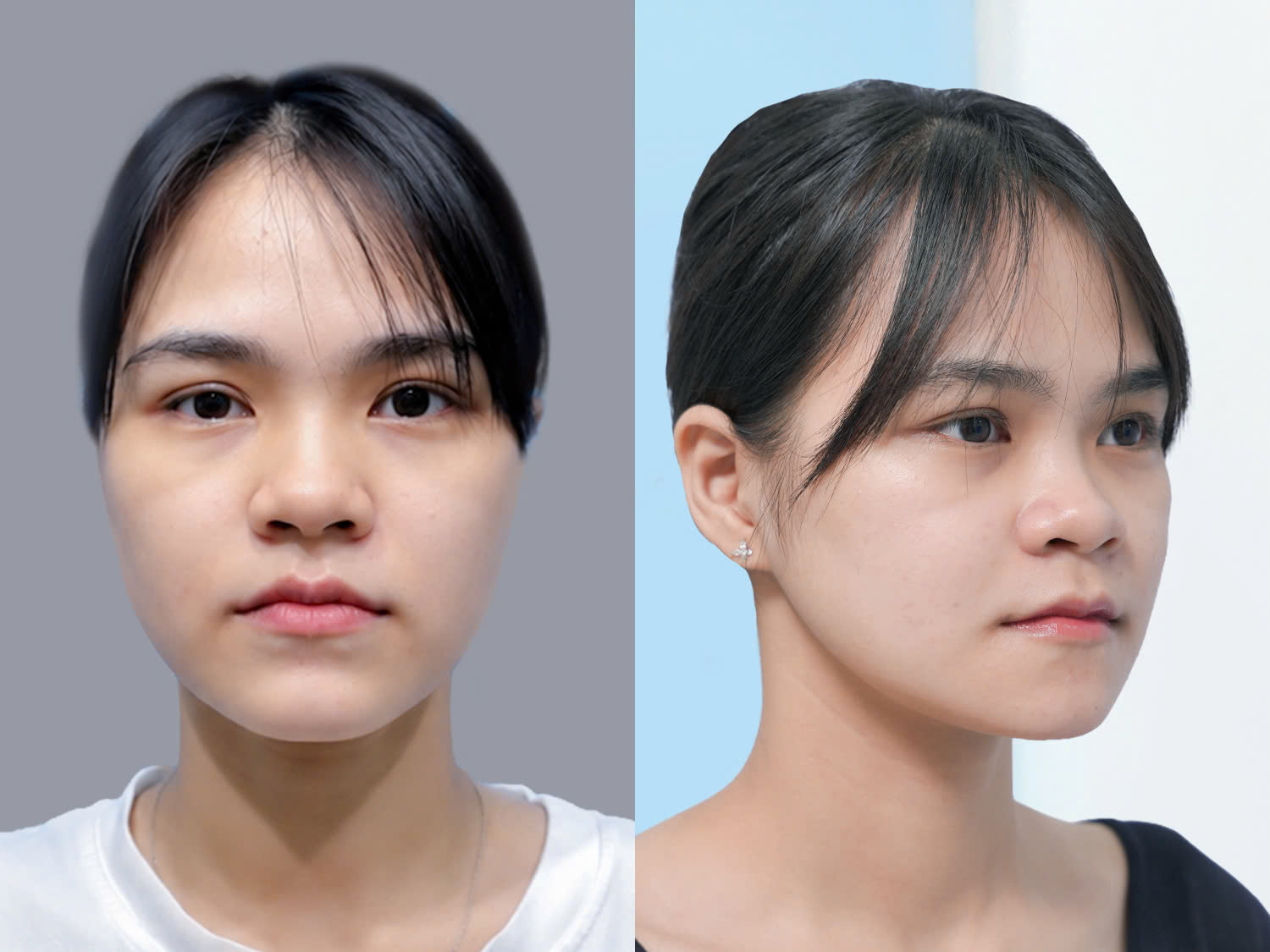 Diện mạo của Mỹ Hương sau 2 tháng chỉnh hàm, khuôn mặt đã cân đối hơn