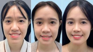 14 ngày khắc phục “mặt lưỡi cày” bằng chỉnh hàm móm 3D của cô gái trẻ Thùy Linh