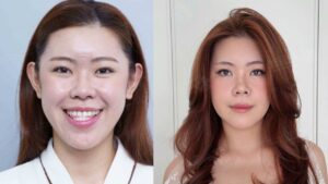 Tiktoker Đông Có Anh với hơn 505.000 lượt theo dõi “lột xác” sau 60 ngày chỉnh hàm móm tại Kangnam Hà Nội