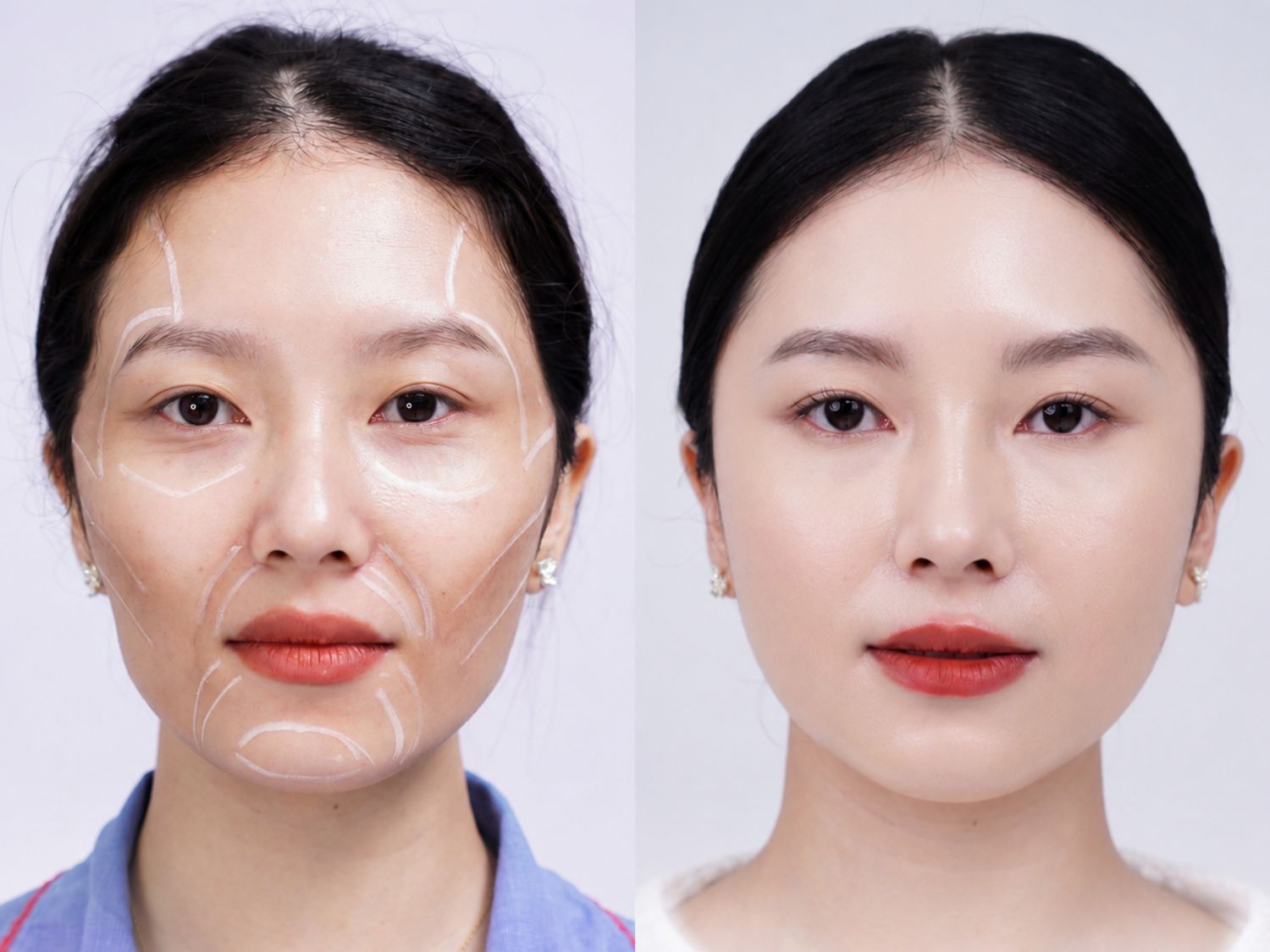 Chất lượng làn da sau cấy mỡ đa tầng Matrix 3D tươi trẻ, mềm mịn và căng bóng hơn