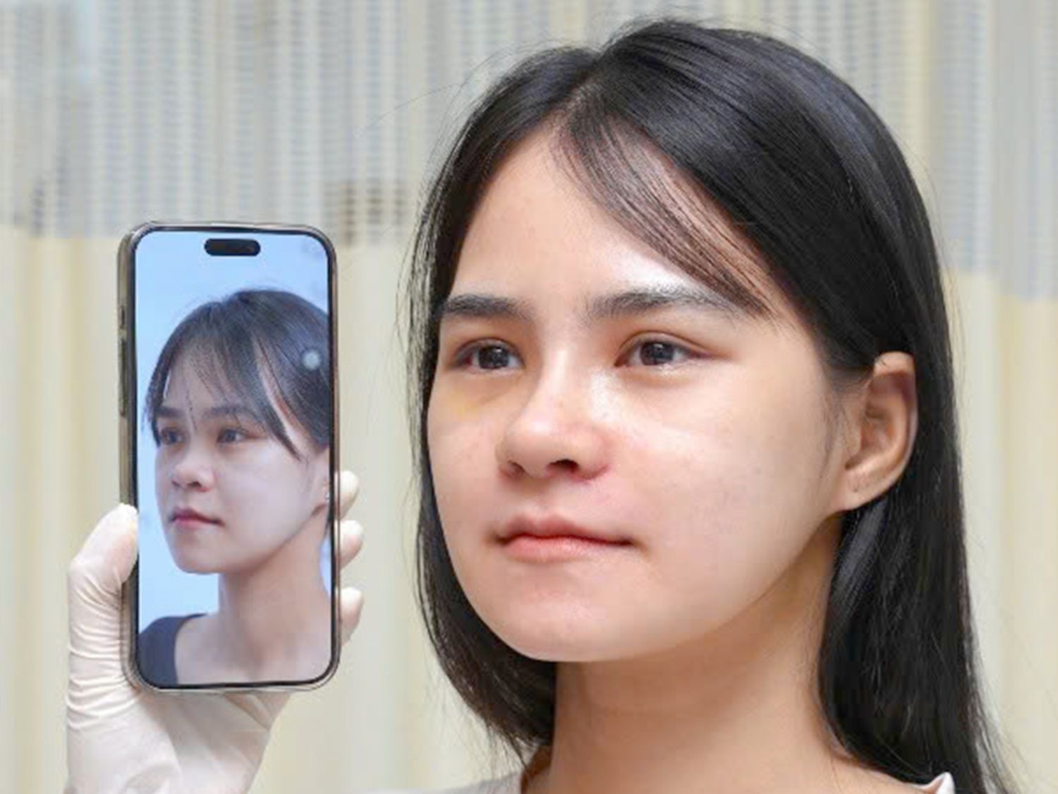 Sau khi chỉnh hàm và nâng mũi gương mặt Mỹ Hương đã thanh thoát, tự nhiên hơn