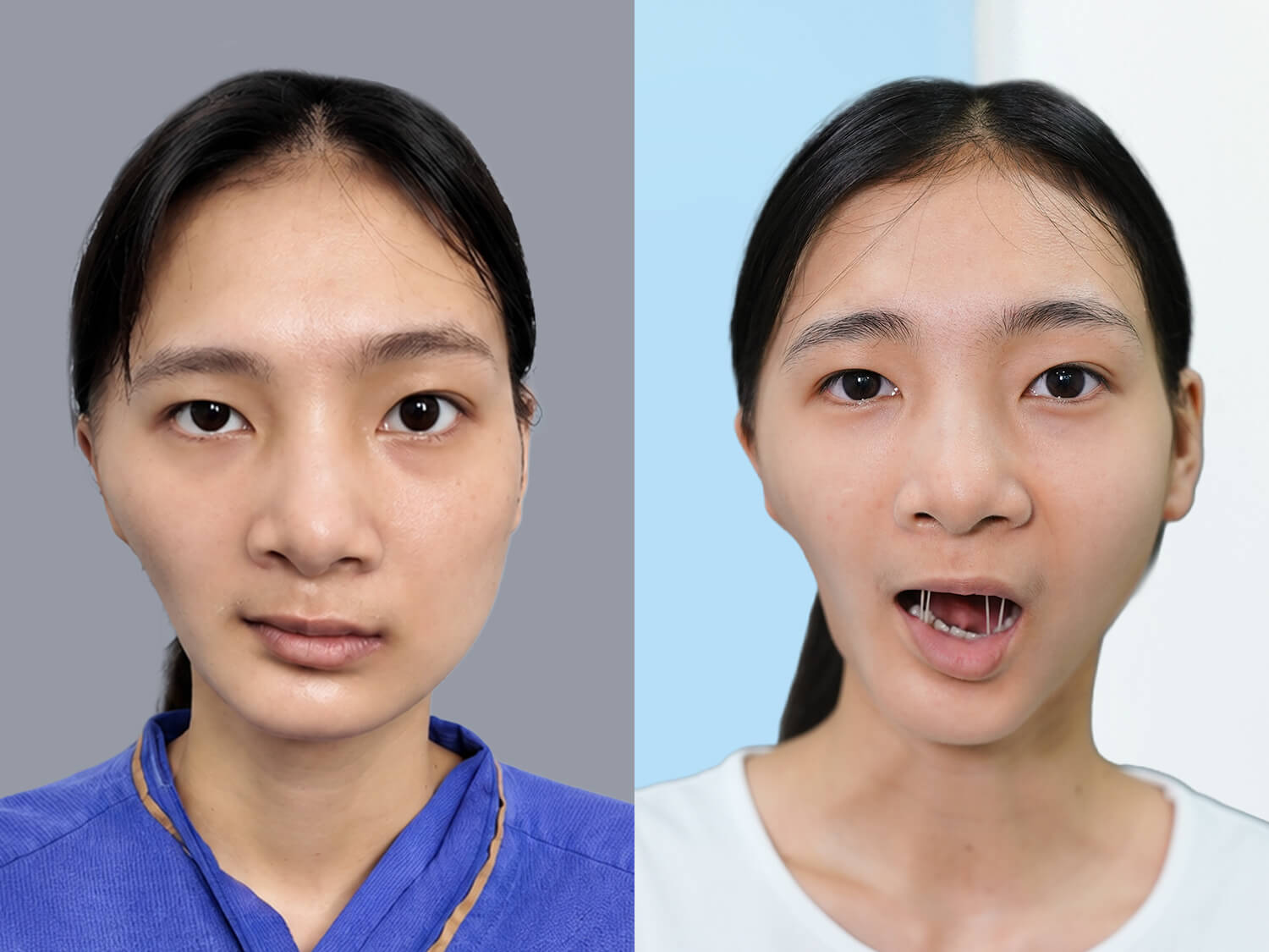 Sự thay đổi của Diệu sau 2 tháng thực hiện phẫu thuật