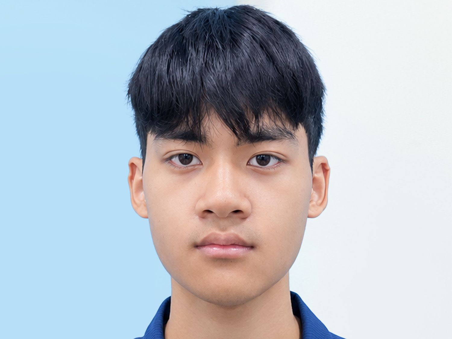 Sau chỉnh hàm móm gương mặt của em Quyết đã cân đối hơn