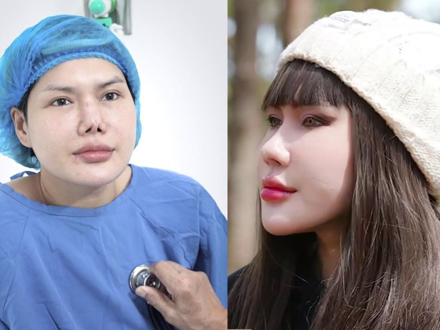 Sau 3 tháng, Trần Thị Quỳnh Mai lấy lại chiếc mũi đầy đặn, như ý