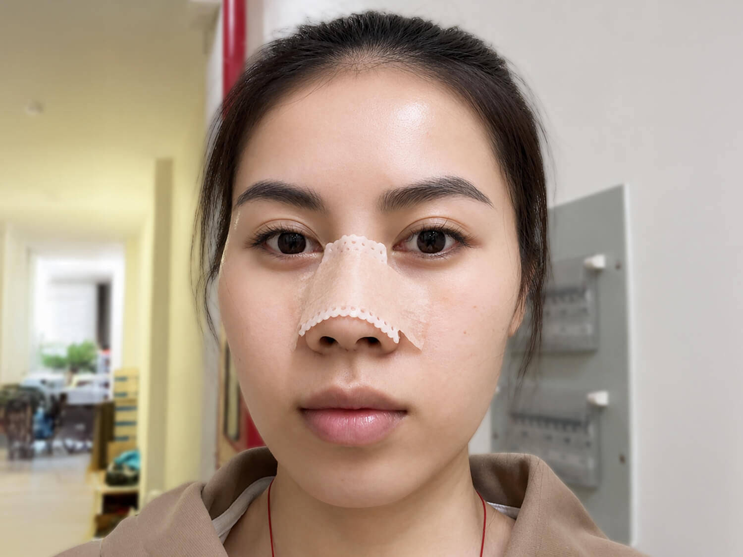 Sau 5 ngày mũi vẫn còn hơi sưng tấy