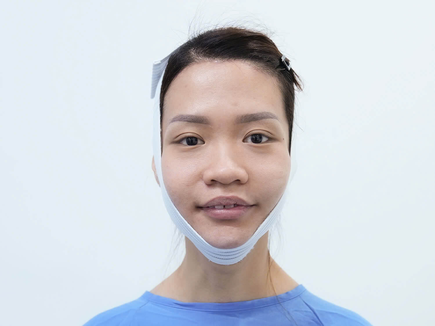Khuôn mặt của Tình sau khi phẫu thuật được 3 ngày