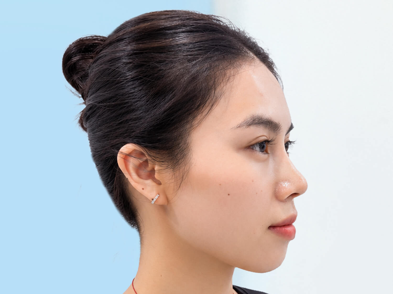 Sau tái khám 1 tháng dáng mũi đã gom dần, vào form chuẩn đẹp