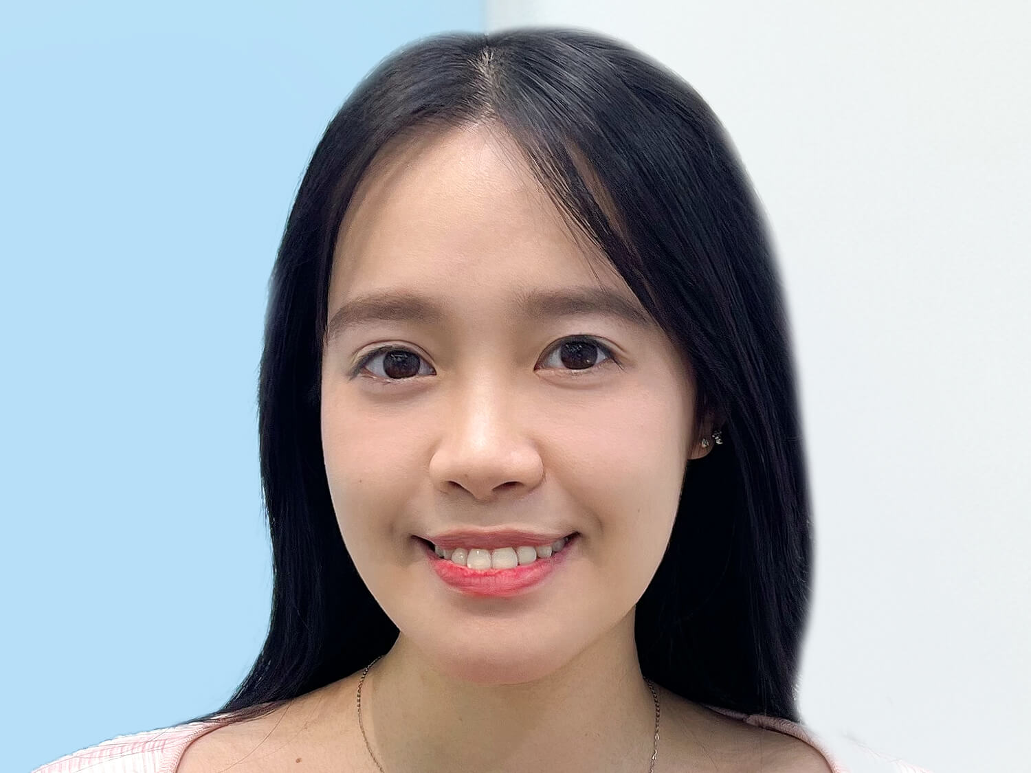 Sau 1 tháng gương mặt của Linh đã ổn định và cân đối, khắc phục hiệu quả tình trạng hàm móm