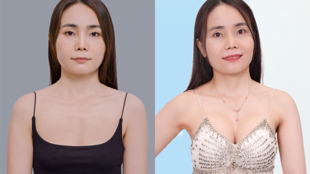 Sau 14 ngày nâng ngực 6D không chạm, mẹ 2 con Thúy Nguyễn tìm lại vòng một căng tròn, tự nhiên