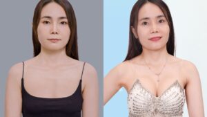 Sau 14 ngày nâng ngực 6D không chạm, mẹ 2 con Thúy Nguyễn tìm lại vòng một căng tròn, tự nhiên