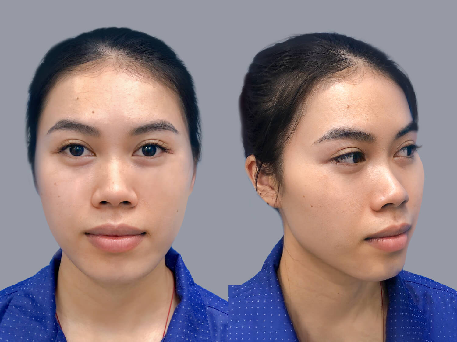 Ái Vy gặp tình trạng sống mũi thấp, đầu mũi khá ngắn