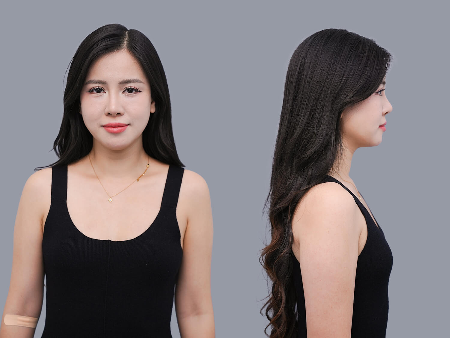 Hoàng Yến gặp tình trạng ngực nhỏ, thiếu mô tuyến