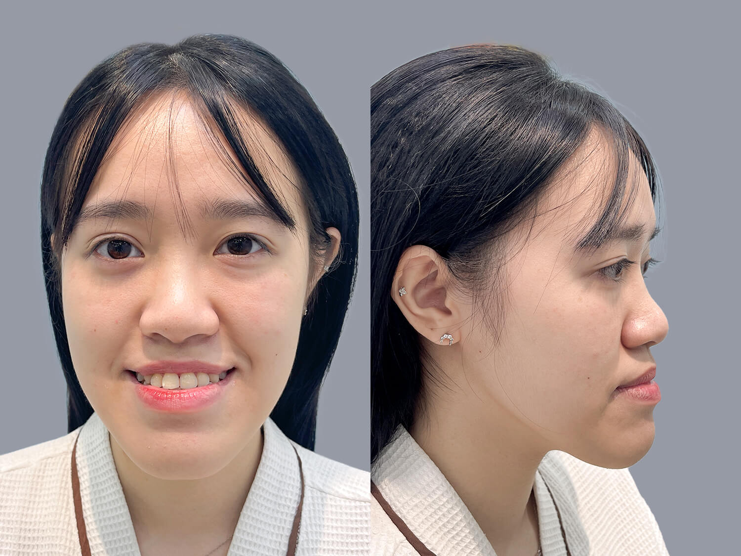 Thùy Linh gặp tình trạng hàm dưới phát triển quá mức, khớp cắn ngược