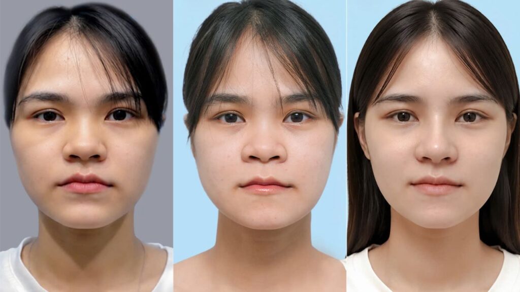 Mỹ Hương lột sau sau 60 ngày chỉnh hàm, nâng mũi Idol Surgiform tại Kangnam Sài Gòn