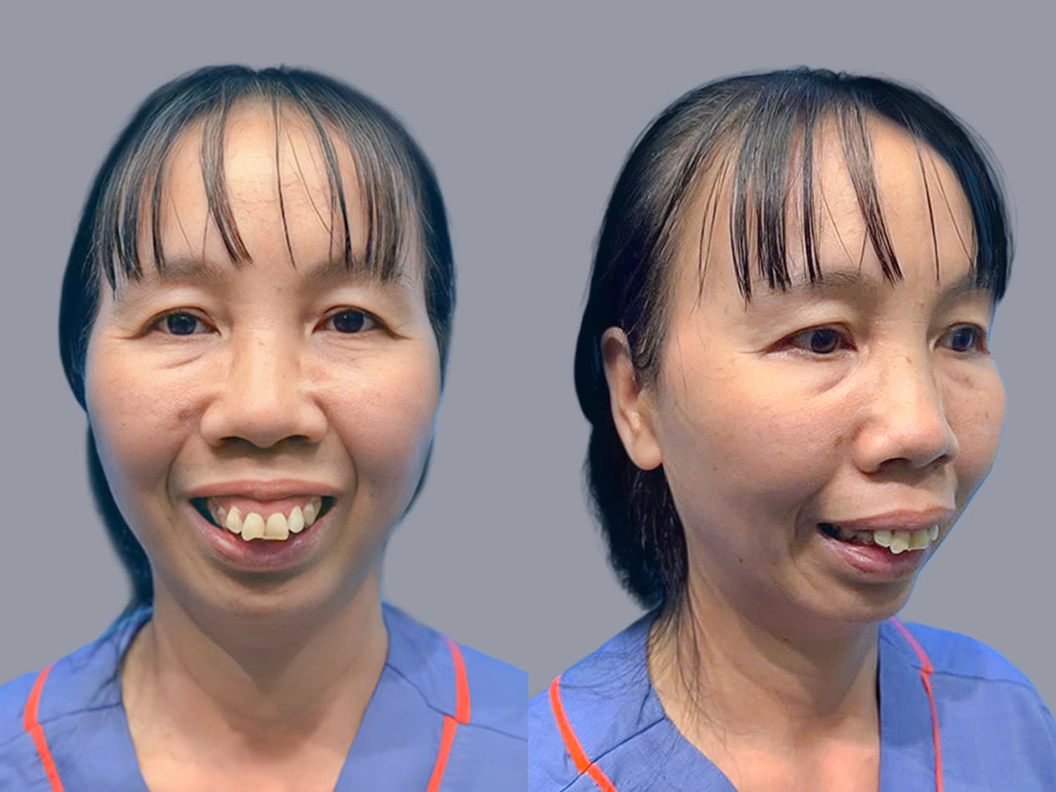 Cô Thảo gặp tình trạng hàm hô nặng, cằm ngắn