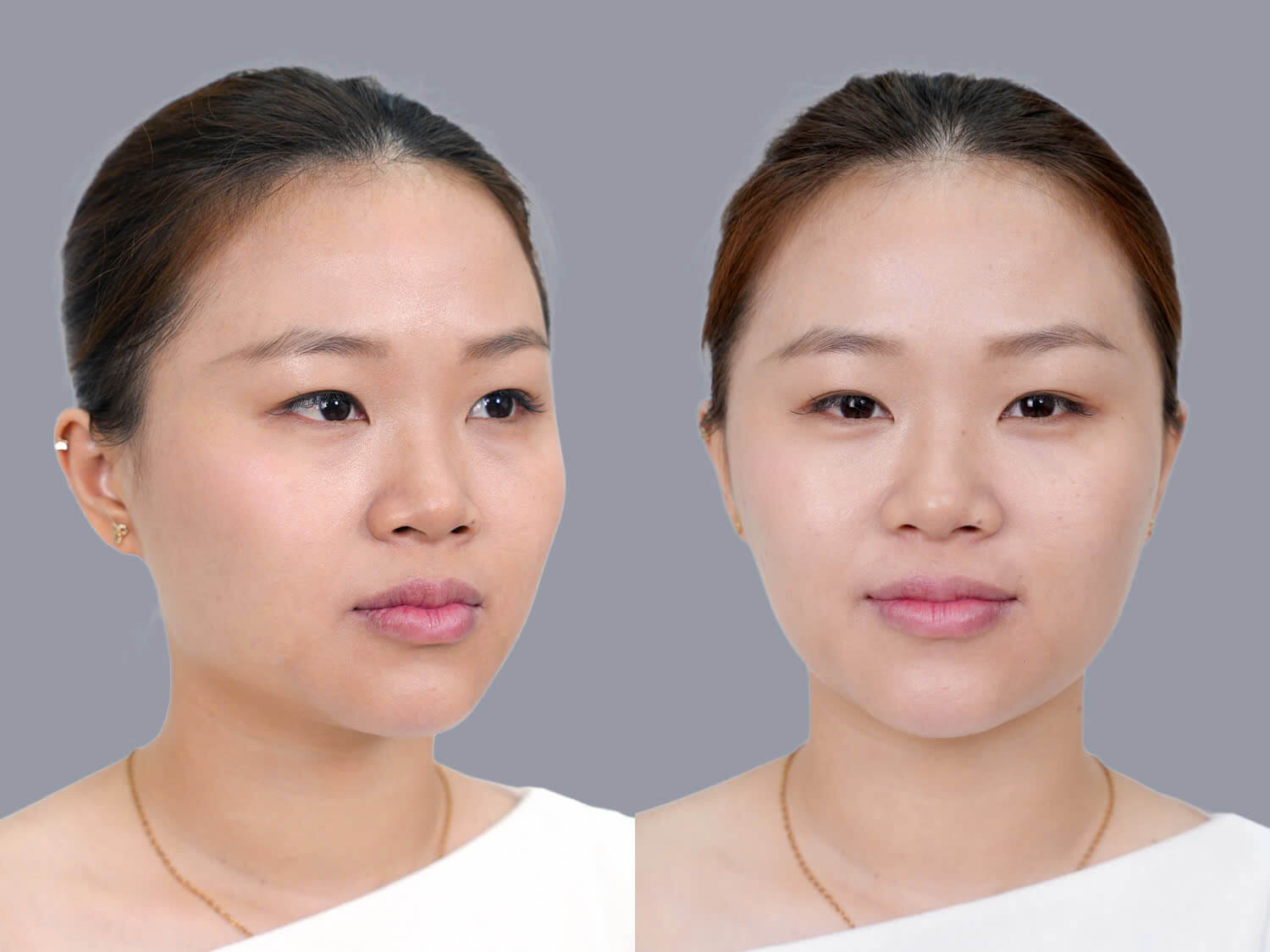 Diệu Hiền gặp tình trạng mắt nhỏ, mí ẩn và sống mũi thấp, tẹt