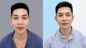 Sau 14 ngày khắc phục thái dương hõm má hóp bằng cấy mỡ Biofat cho khách hàng Việt kiều Pháp