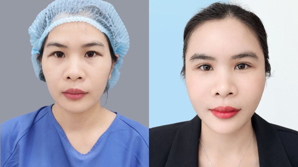 Võ Thị Tỉnh trẻ ra 10 tuổi sau 7 ngày cấy mỡ Biofat và tạo khóe mắt tại Kangnam Sài Gòn