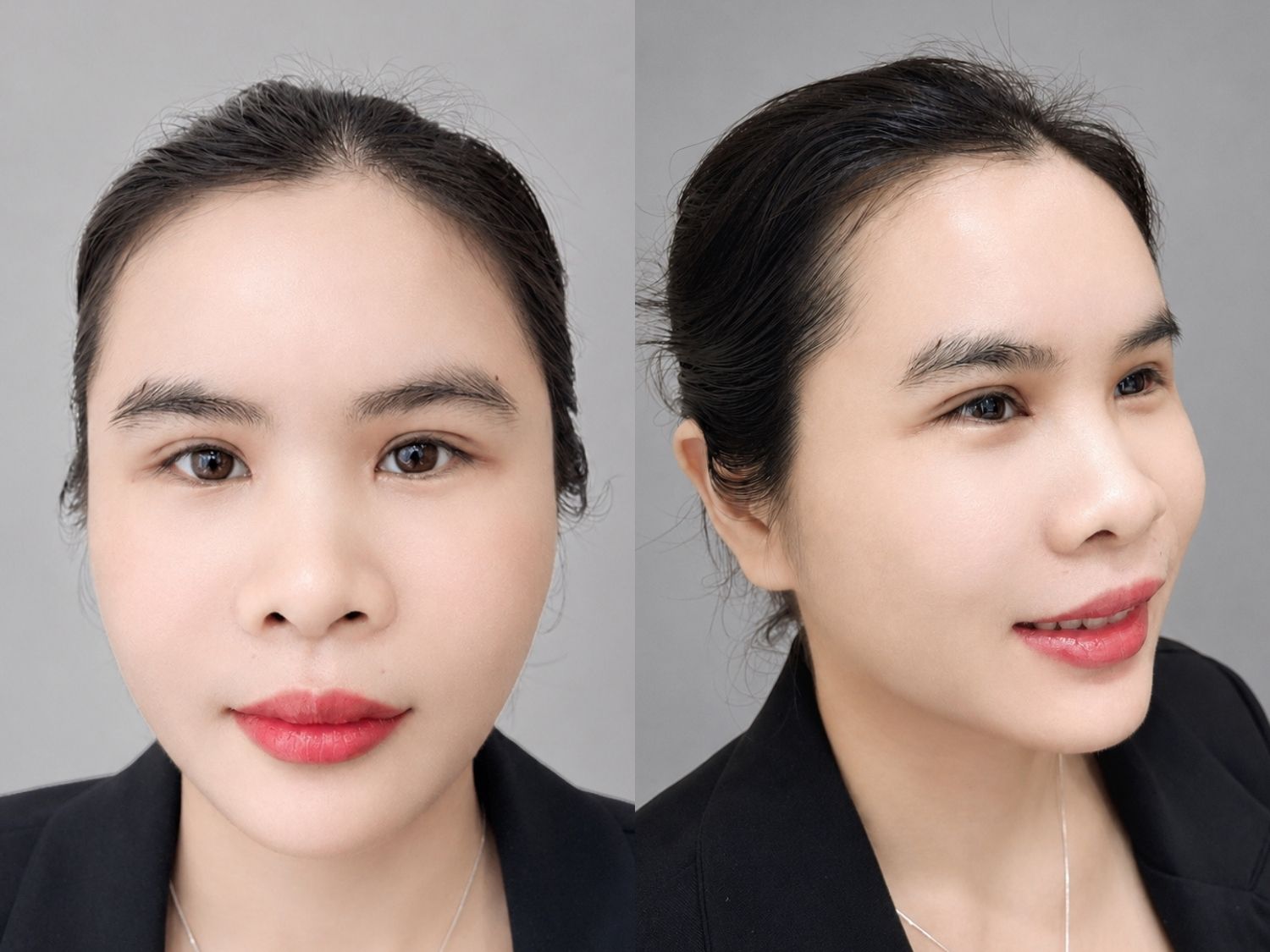 Sau cấy mỡ khuôn mặt chị Tỉnh đã đầy đặn, tròn đầy và mịn màng hơn