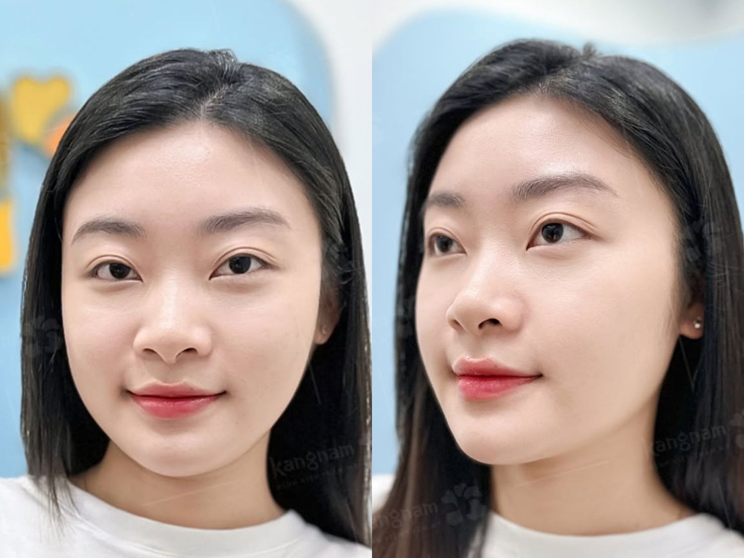 Sau 14 ngày khuôn mặt của Yến Nhi đã bớt sưng, dần vào form thon gọn hơn