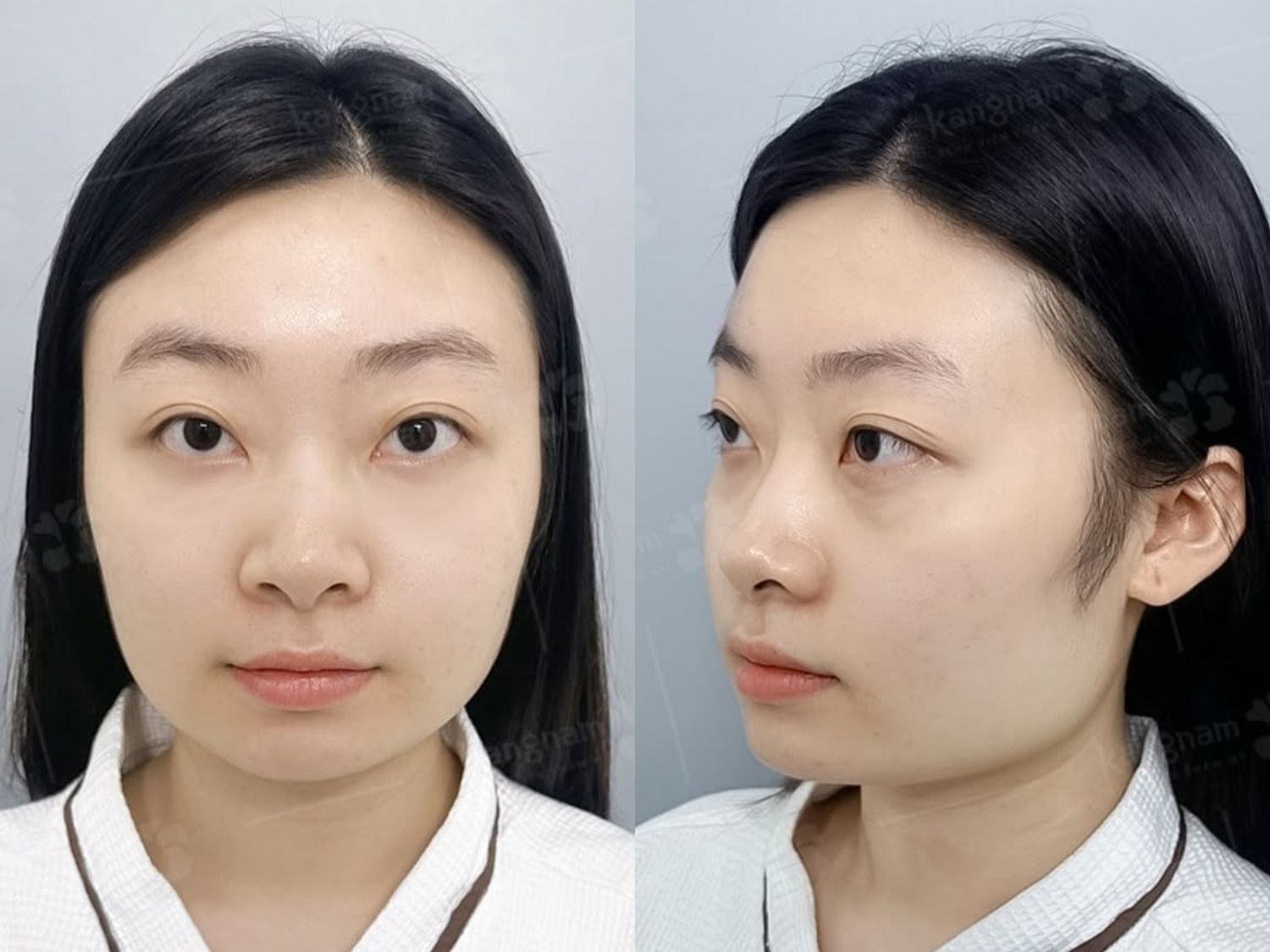Trước phẫu thuật Yến Nhi gặp tình trạng hàm to, bạnh