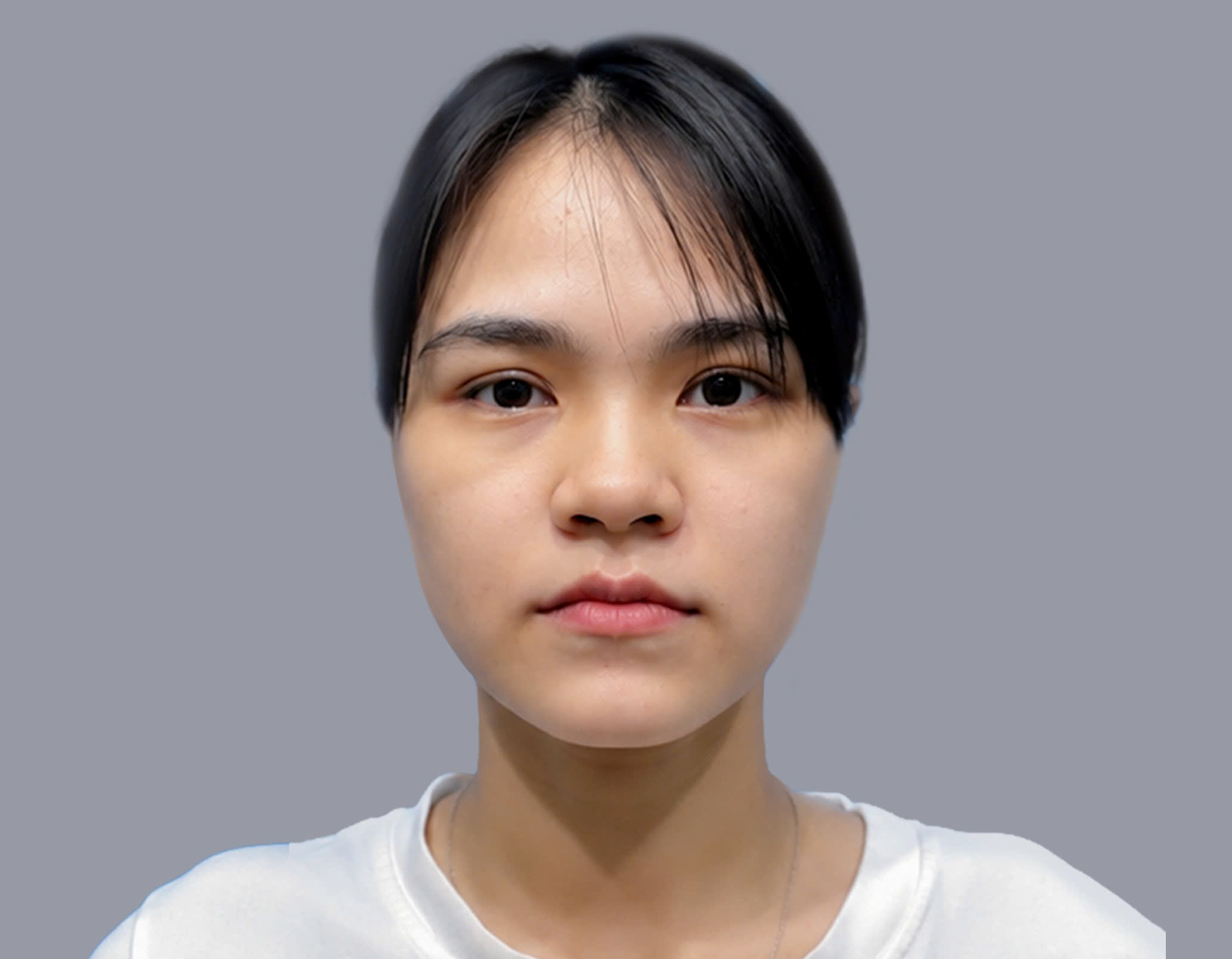 Mỹ Hương gặp tình trạng hàm trên lùi vào trong, hàm dưới dài quá mức, sống mũi thấp