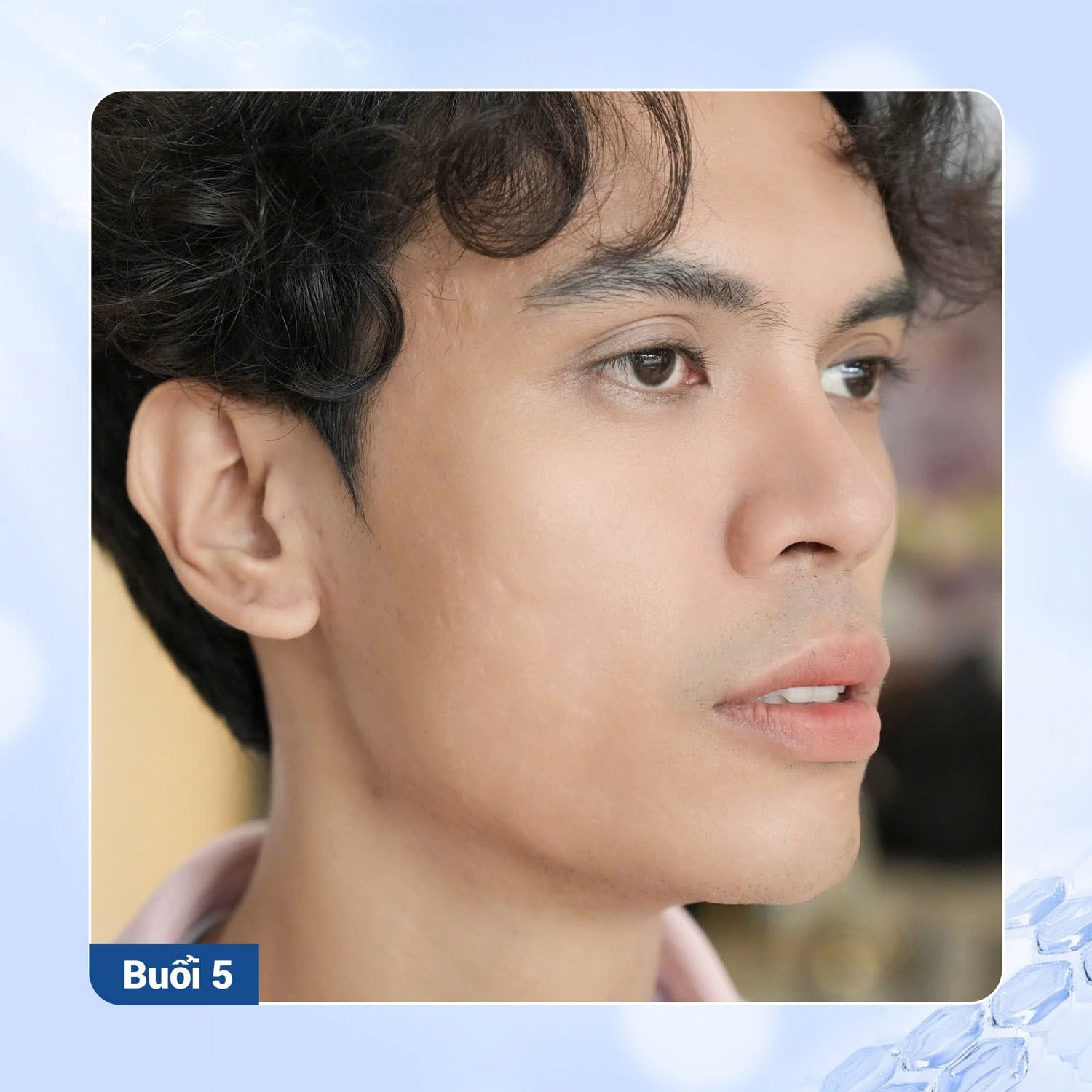 Làn da cải thiện rõ sau 5 ngày