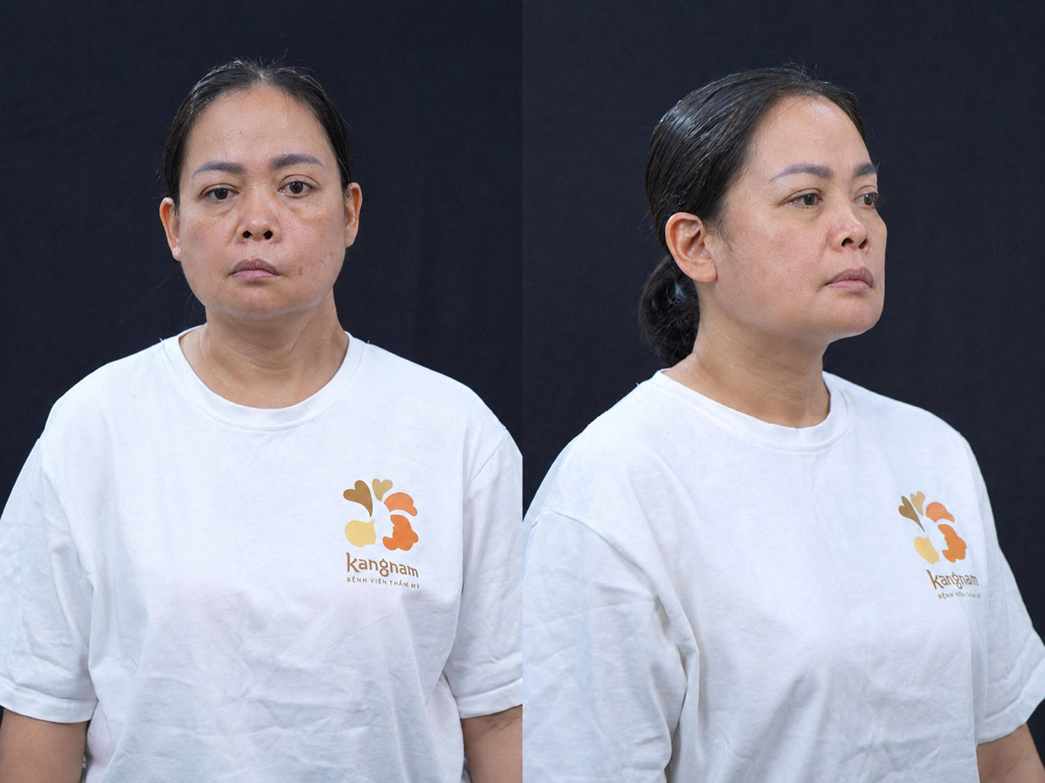 tình trạng liệt dây thần kinh của Bạch Tuyết
