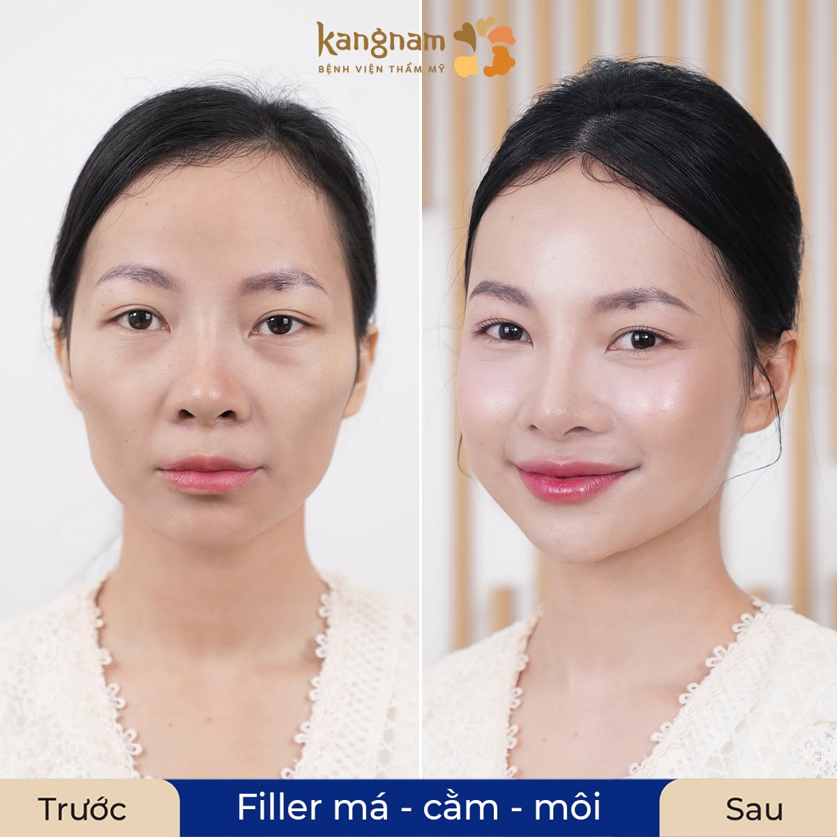 Vùng má và thái dương được lấp đầy mềm mại, nhìn ảnh so sánh thấy gương mặt trẻ rõ