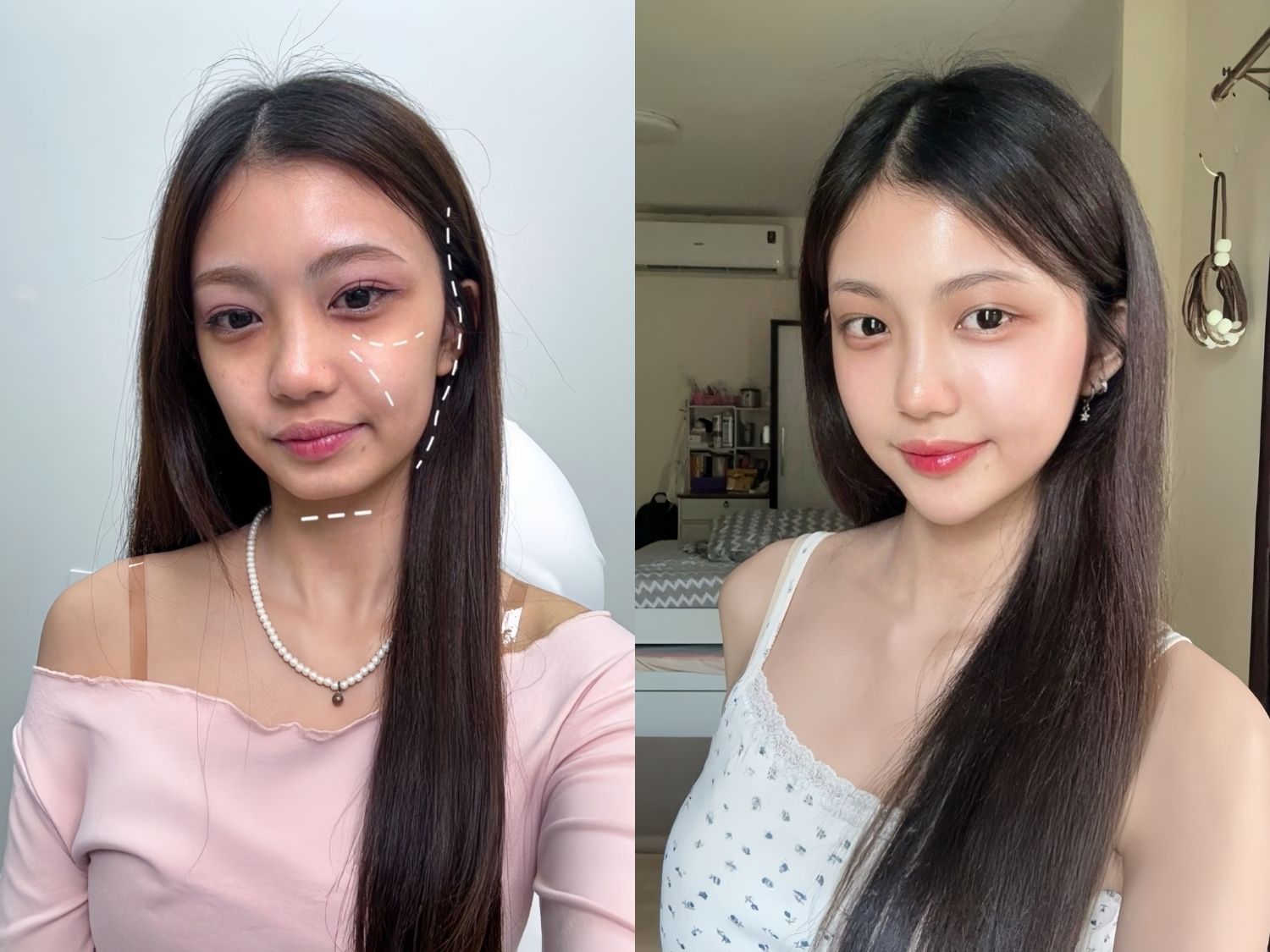 ảnh so sánh trước và sau khi tiêm filler của Thư, filler định hình ổn định, tương thích với các mô cơ thể