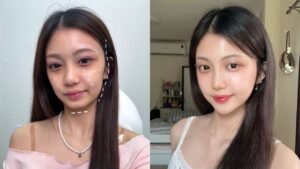Tiêm filler cải thiện má hóp, thái dương trũng cho khách hàng Anh Thư