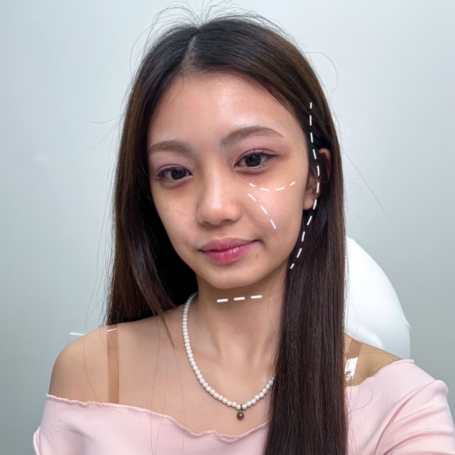 tình trạng của Thư trước khi tiêm filler là Má hóp và thái dương hóp sâu
