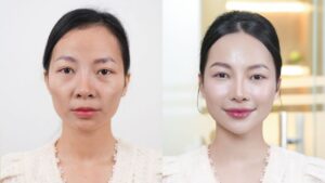 Tạm biệt má hóp, rãnh cười sâu cùng Linh sau tiêm Filler