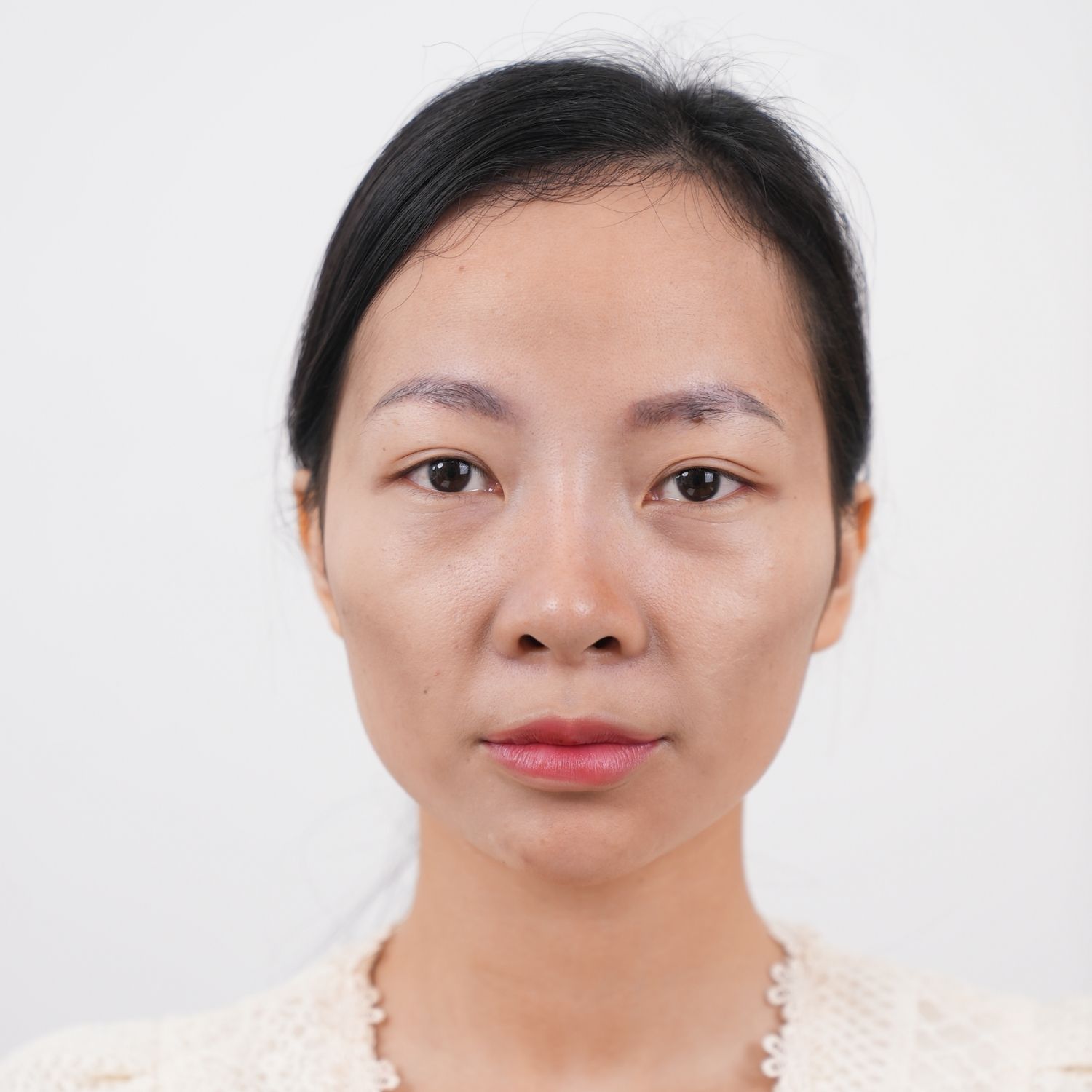 Tình trạng da của Linh Hai bên má và thái dương hóp sâu