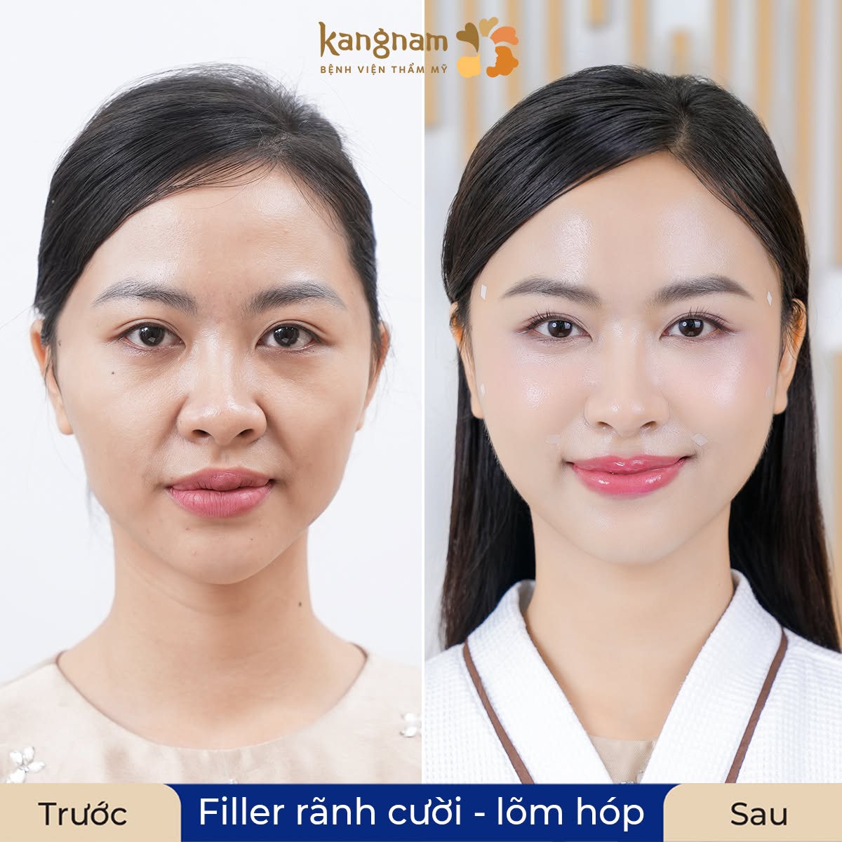 Khách hàng Minh Anh sau khi tiêm filler đạt đến độ tự nhiên tối đa. Đường nét khuôn mặt hài hòa, trẻ trung